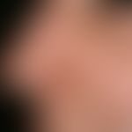 Fig. 11 a: Excisional defect of the nostril left to secondary healing after removal of a basal ce...