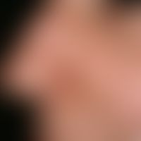 Fig. 11 a: Excisional defect of the nostril left to secondary healing after removal of a basal ce...