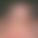 Skin transplantation, faulty. Fig. 11 b: Distortion of the nasal wing cranially due to scar tissu...