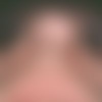 Skin transplantation, faulty. Fig. 11 b: Distortion of the nasal wing cranially due to scar tissu...