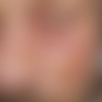 O-to-Y-plasty. postoperative bent Y-shaped suture after extension surgery and primary suture of t...