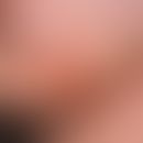 Rotational flap plasty, submandibular. nodular, centrally erosive tumor, raised above the skin le...
