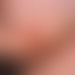 Rotational flap plasty, submandibular. nodular, centrally erosive tumor, raised above the skin le...