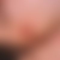 Rotational flap plasty, submandibular. nodular, centrally erosive tumor, raised above the skin le...