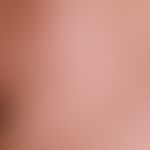Rotational flap plasty, submandibular. documentation of the course: skin condition 6 months after...