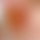 Rotationsverschiebelappen, einfacher. Basalzellkarzinom innerhalb eines Radioderms in der Achselh...