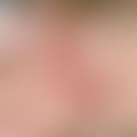 Rotationally displaced flap, simple. documentation of the course: skin condition 5 weeks after th...