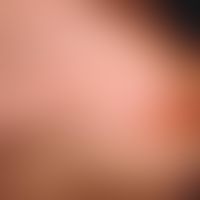 Fig. 1: Hypertrophic scar not following the course of the skin relaxation lines (?RSTL?) with ?ro...