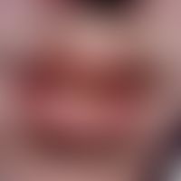 Fig. 2 a: Post-traumatic,incorrectly treated and chronically infected scar on the lower lip of a ...