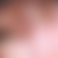 Incision, faulty. fig. 10 a: Nodular, superficially slightly eroded tumor, interspersed with tela...