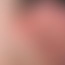 Vollhauttransplantation, kombinierte. Abb. 1 a: Über dem Hautniveau erhabener, ulzerierter, oberf...