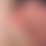 Vollhauttransplantation, kombinierte. Abb. 1 a: Über dem Hautniveau erhabener, ulzerierter, oberf...
