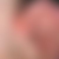 Vollhauttransplantation, kombinierte. Abb. 1 a: Über dem Hautniveau erhabener, ulzerierter, oberf...