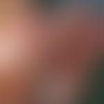 Vollhauttransplantation, kombinierte. Abb. 1 b: Nahtverhältnisse nach ovaler Tumorexzision, Minim...