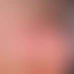 Vollhauttransplantation, kombinierte. Abb. 1 c: Verlaufsdokumentation: Hautzustand 3 Jahre post o...