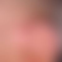Vollhauttransplantation, kombinierte. Abb. 1 c: Verlaufsdokumentation: Hautzustand 3 Jahre post o...