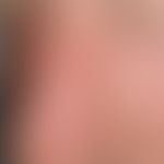 Vollhauttransplantation, kombinierte. Abb. 2 a: Mehrere kleine Ulzerationen, umgeben von einem an...