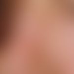 Vollhauttransplantation, kombinierte. Abb. 2 c: Verlaufsdokumentation: Hautzustand 3 Jahre post o...