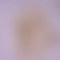 Fasciolopsiasis. egg of Fasciolopsis buski. the egg is very similar to the egg of Fasciola hepati...