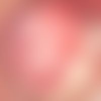 Anoscopy, high-resolution, inconspicuous transformation zone (linea dentata) without clinically v...