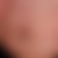 Splitterblutung:&nbsp;nicht ganz frische,lineare, subunguale Hämorrhagien.&nbsp;
