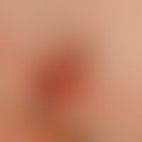 Splitterblutung:&nbsp;auflichtmikroskopische Bild der nicht ganz frischen Einblutungen.
