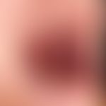 Malformationen venöse : langsam wachsende, klinisch symptomlose (gelegentliches verstärktes Blute...
