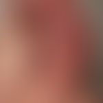 Malformationen, vaskuläre: nicht-syndromale,&nbsp;gemischte kapilläre/venöse Malformation.&nbsp;
