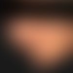 Malformationen, vaskuläre. Gemischte venös/kapilläre Malformation mit überwiegendem, subkutanen v...