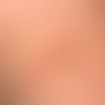 Malformationen, vaskuläre (Lymphatische Malformation): "&nbsp;Lymphangioma circumscriptum"&nbsp; ...