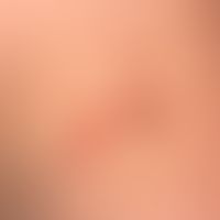Malformationen, vaskuläre (Lymphatische Malformation): "&nbsp;Lymphangioma circumscriptum"&nbsp; ...