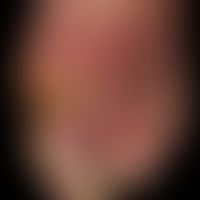 Foot syndrome, diabetic, proven severe polyneuropathy, malum perforans and gram-negative foot ins...
