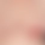 Wunde,chronische. Beidseitige Brustverkleienerung. Nicht heilende Wunde im Narbenbereich.
