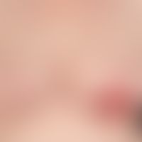 Wunde,chronische. Beidseitige Brustverkleienerung. Nicht heilende Wunde im Narbenbereich.
