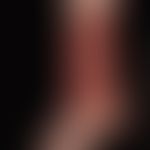 Wunde, chronische. Ulcus cruris venosum
