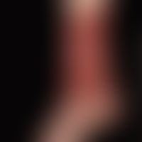 Wunde, chronische. Ulcus cruris venosum
