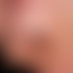 Wunde, chronische. Pyoderma gangraenosum unter Chemotherapie
