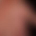 Handdermatitis: Akuter&nbsp;dyshidrotischer Schub einer&nbsp;chronischen Handdermatitis.
