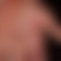 Handdermatitis: Akuter&nbsp;dyshidrotischer Schub einer&nbsp;chronischen Handdermatitis.
