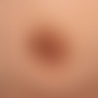 Beidseitige erworbene Keratosis areolae mammae bei&nbsp;paraneoplastischer Akrokeratose
