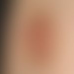 Keratosis areolae mammae acquisita. Ursache ungeklärt.
