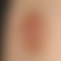 Keratosis areolae mammae acquisita, cause unknown.
