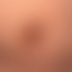 Keratosis areolae mammae acquisita in altersatrophischer, leicht exsikkierter, schuppiger Haut.
