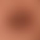 Keratosis areolae mammae acquisita (beidseitig und innerhalb weniger Monate aufgetreten) fortgesc...