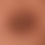 Keratosis areolae mammae acquisita (beidseitig und innerhalb weniger Monate aufgetreten) fortgesc...