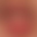 Polyendocrinological syndrome, autoimmunological ectodermal dysplasia with buoy teeth, chronic mu...