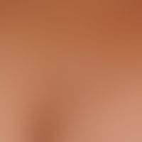 Lichen sclerosus extragenitaler. grouped, symptomless, confetti-like white spots and plaques with...