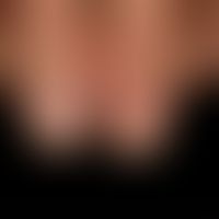 Acrodermatitis chronica suppurativa, initially mild course with purulent inflammation of the prox...