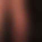 acrodermatitis chronica arophicans. early stage of acrodermatitis chronica atrophicans with still...