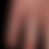 Acrodermatitis continua suppurativa:&nbsp;typisches klinisches Bild. Langjährige Psoriasis bekann...